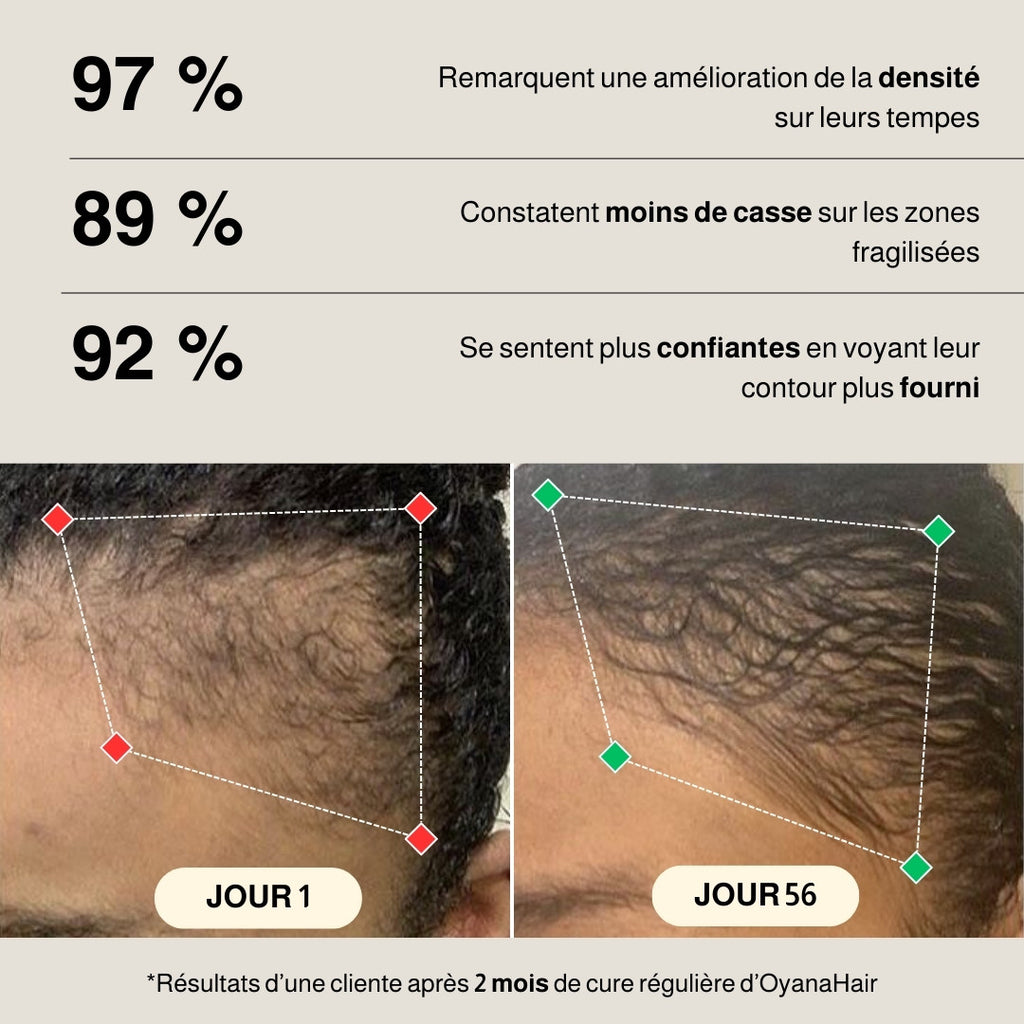 Huile de Batana – Soin Repousse Tempes